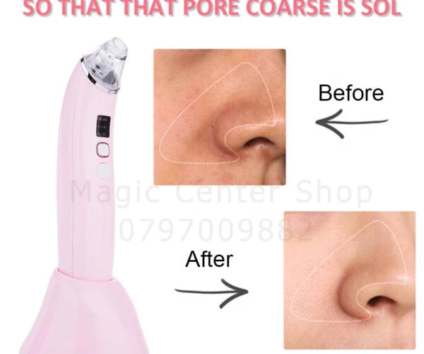 ENZO Blackhead Remover Device