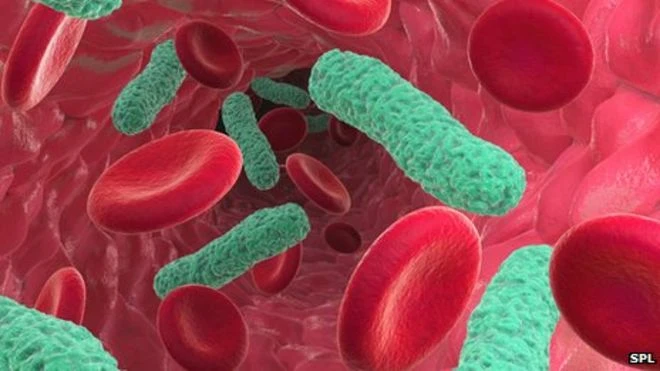 septicemia