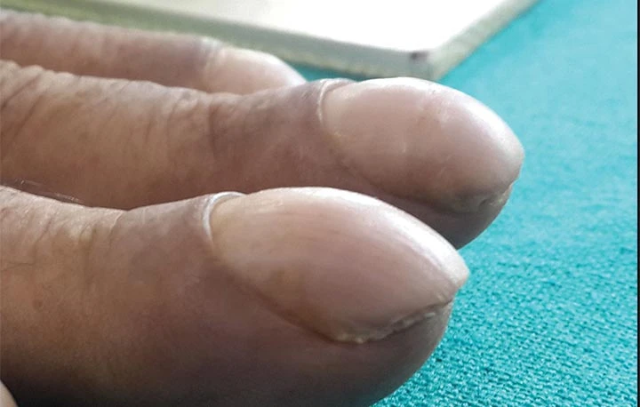 تعجُّر الأظافر (Nail Clubbing)