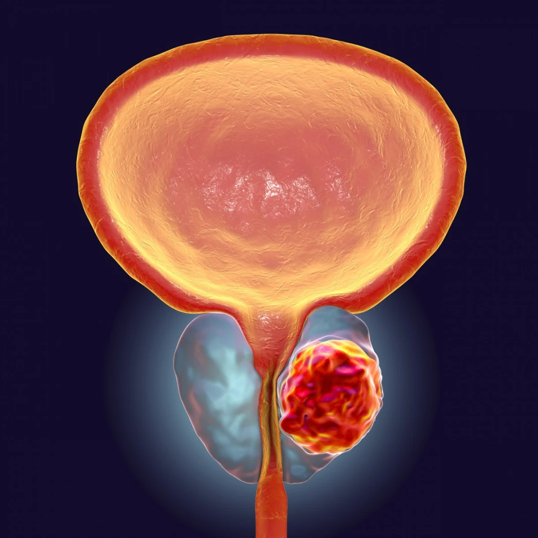 prostate cancer