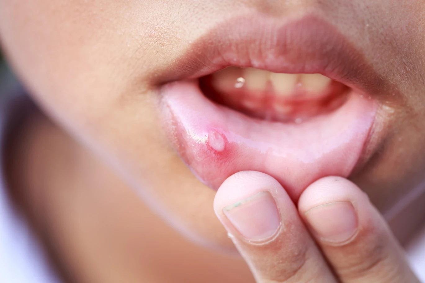 Mouth ulcer
