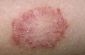 skin fungus