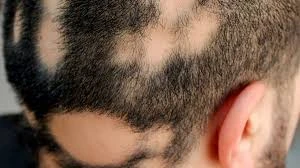 ثعلبة الشعر 