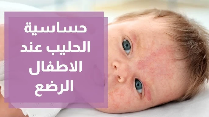 أبرز أعراض حساسية الحليب عند الرضع