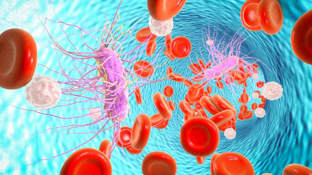 septicemia